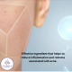 Anti Acne Radiant Glow Face Serum